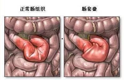 成人肠套叠治疗视频讲解,诊断、治疗与康复全程指导